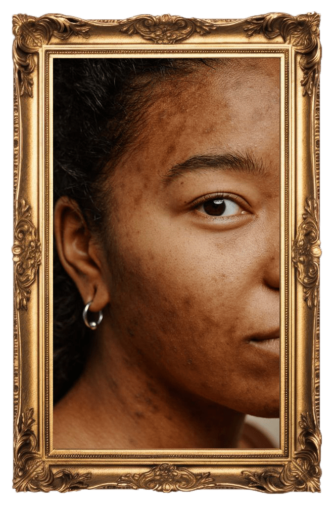 Pigmentation Removal