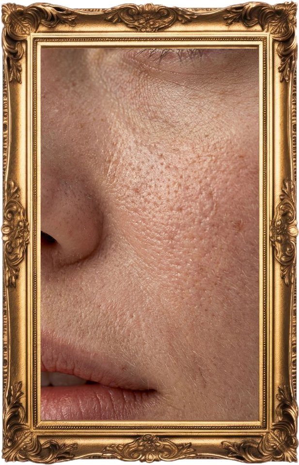 Classic Skin Needling